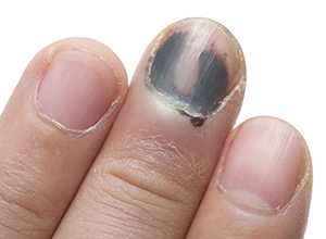 What is the treatment for hematoma under the nails?