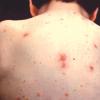 Chicken pox